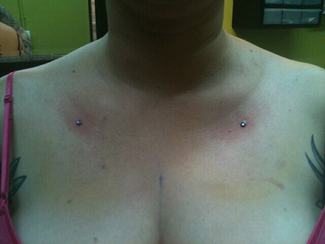 Clavicle surface anchor pair with blue gems