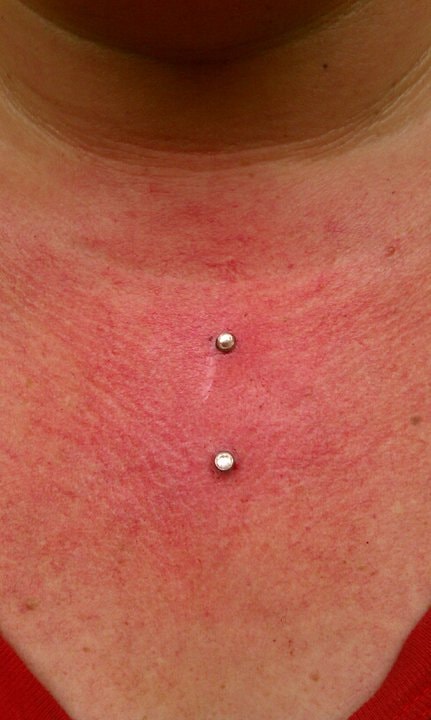 Sternum surface anchor pair — fresh placement