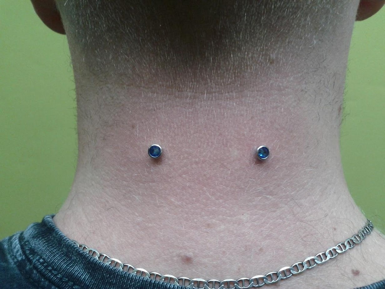 Surface anchor dermals on back of neck